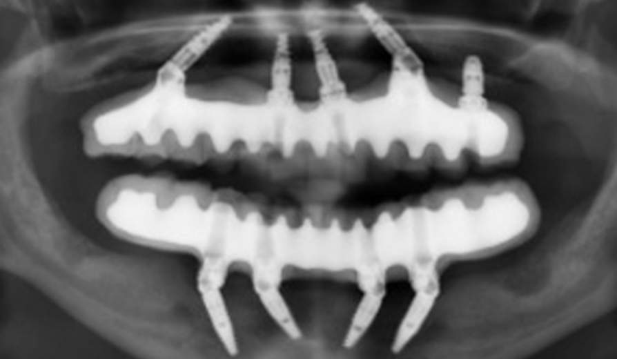 You, your teeth, and Type 2 diabetes; Post-operative panoramic X-ray; fixed implant-supported restoration. Credit: University at Buffalo.