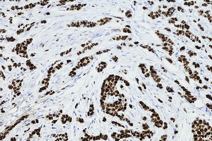 Image of breast cancer cells