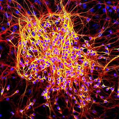 Microscopic image of tau tangle