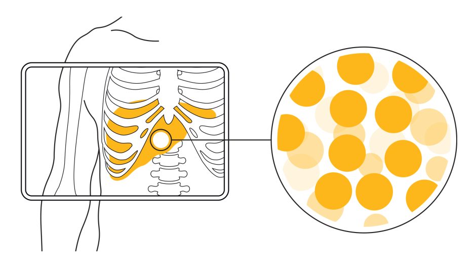 Innovative Yttrium-90 Radioisotopes Revolutionize Liver Cancer Treatment