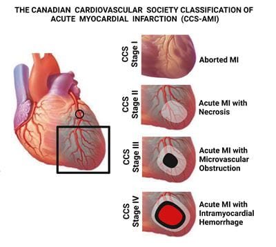 "First ever clinical classification of heart attacks based on tissue damage adopted by Canadian Cardiovascular Society"