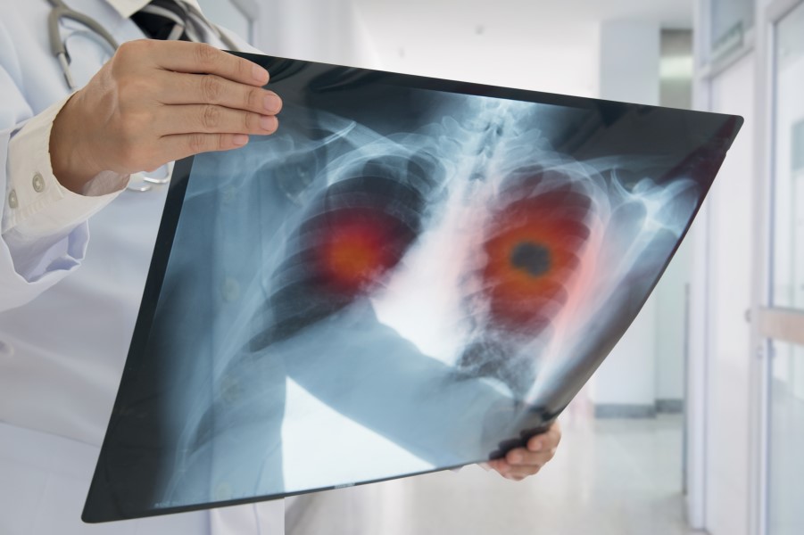 Optimizing Tobacco Cessation Treatment With Lung Cancer Screening
