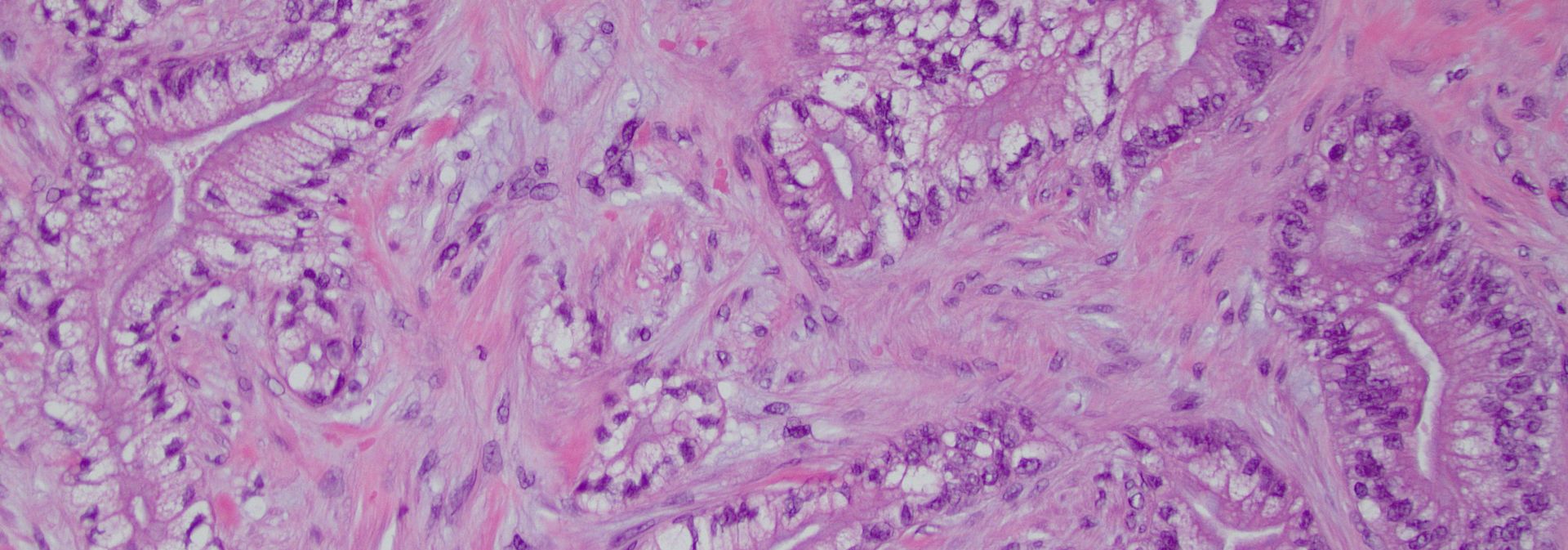 Pancreatic Cancer Discovery Opens the Door for New Clinical Trial