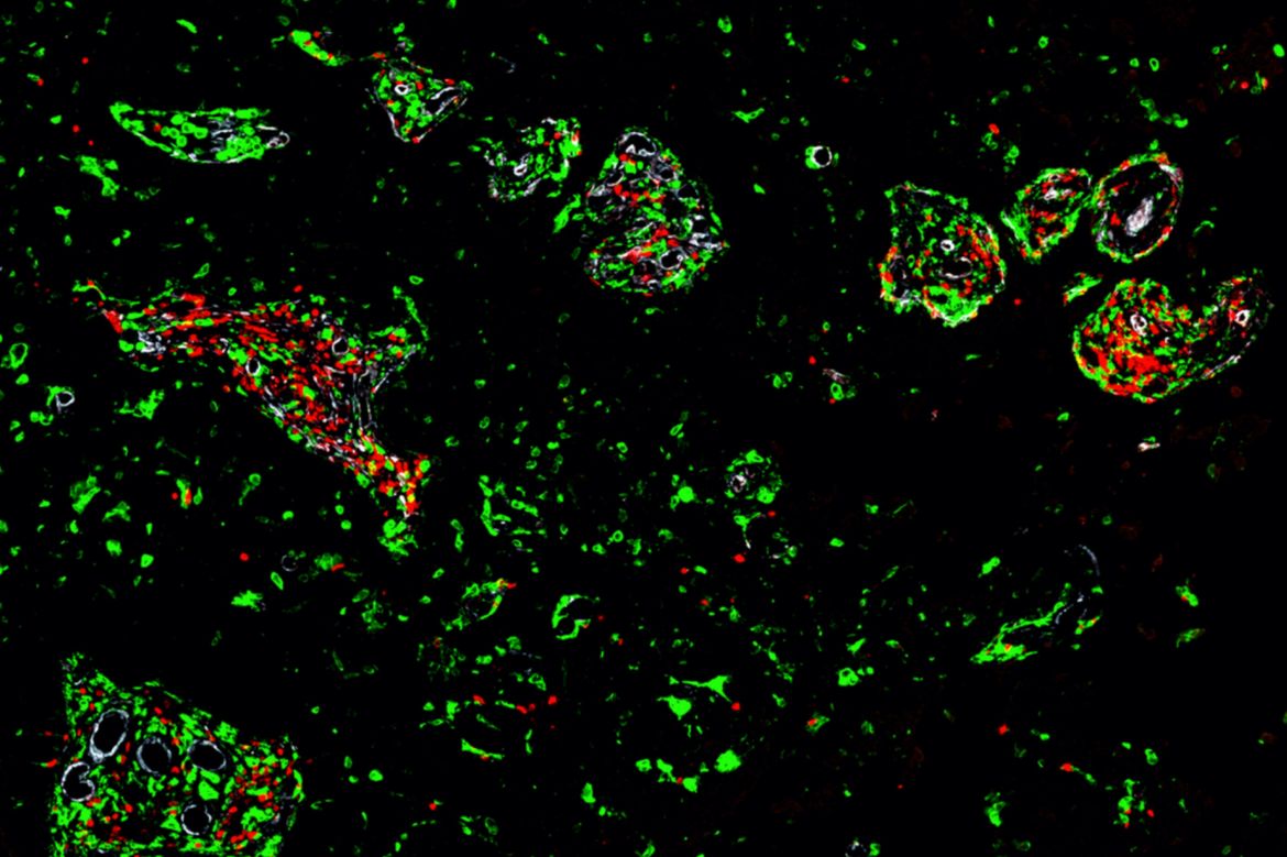 Study Could Help Explain Why Certain Brain Tumors Don’t Respond Well to Immunotherapy