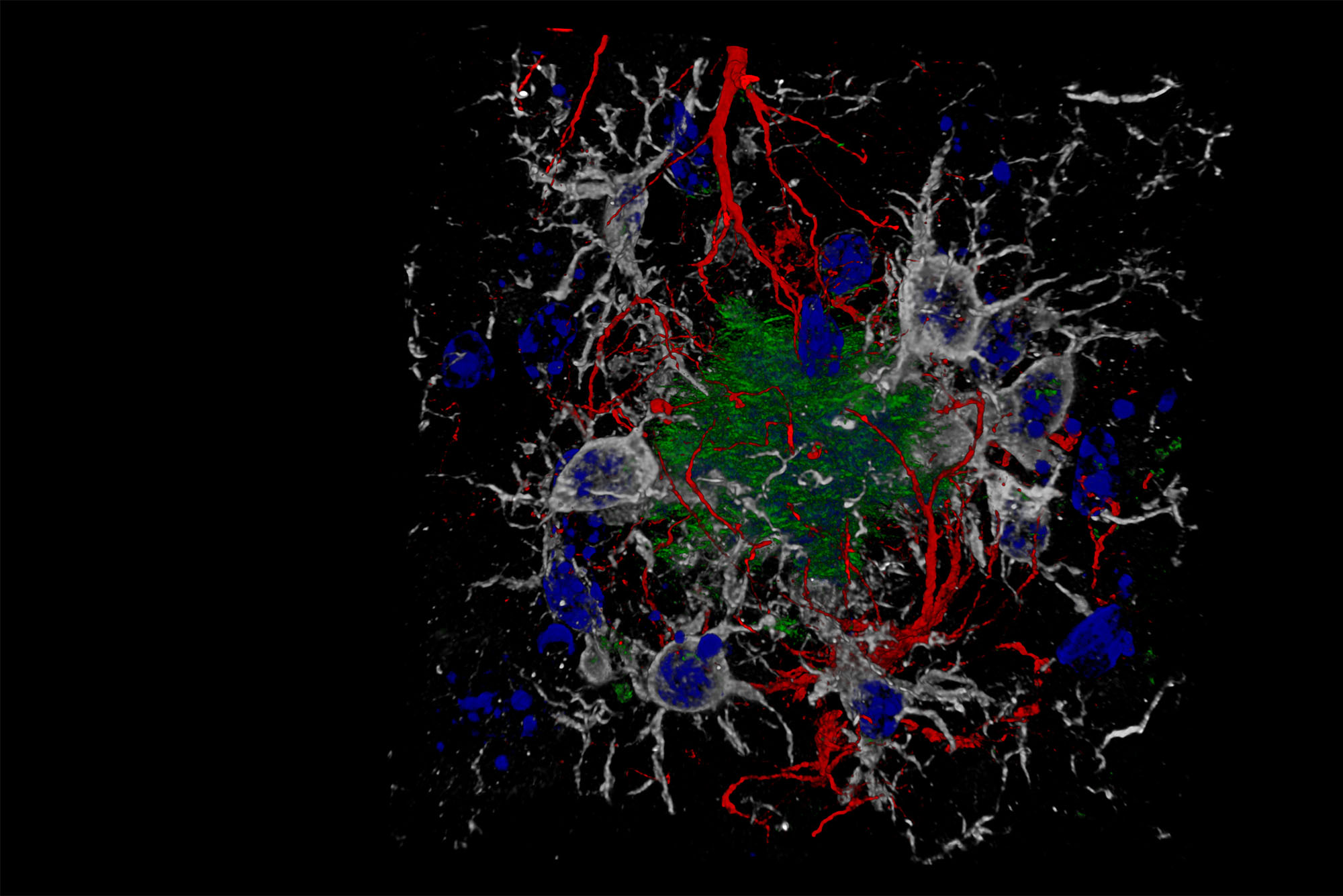 Can We Find a Cure for Alzheimer’s Disease?