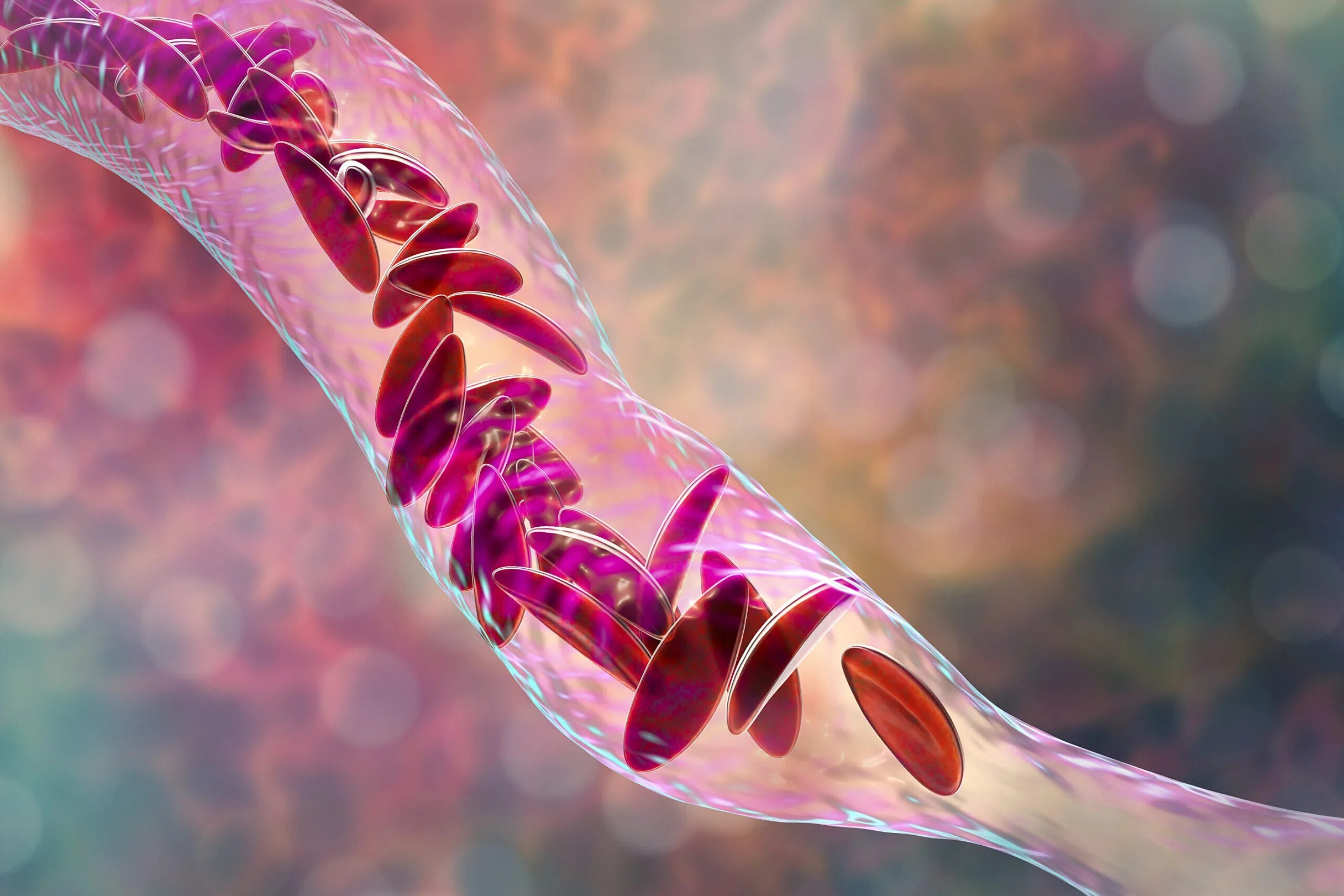 Nursing Researcher Helps Create Global Interventions for Sickle Cell Disease