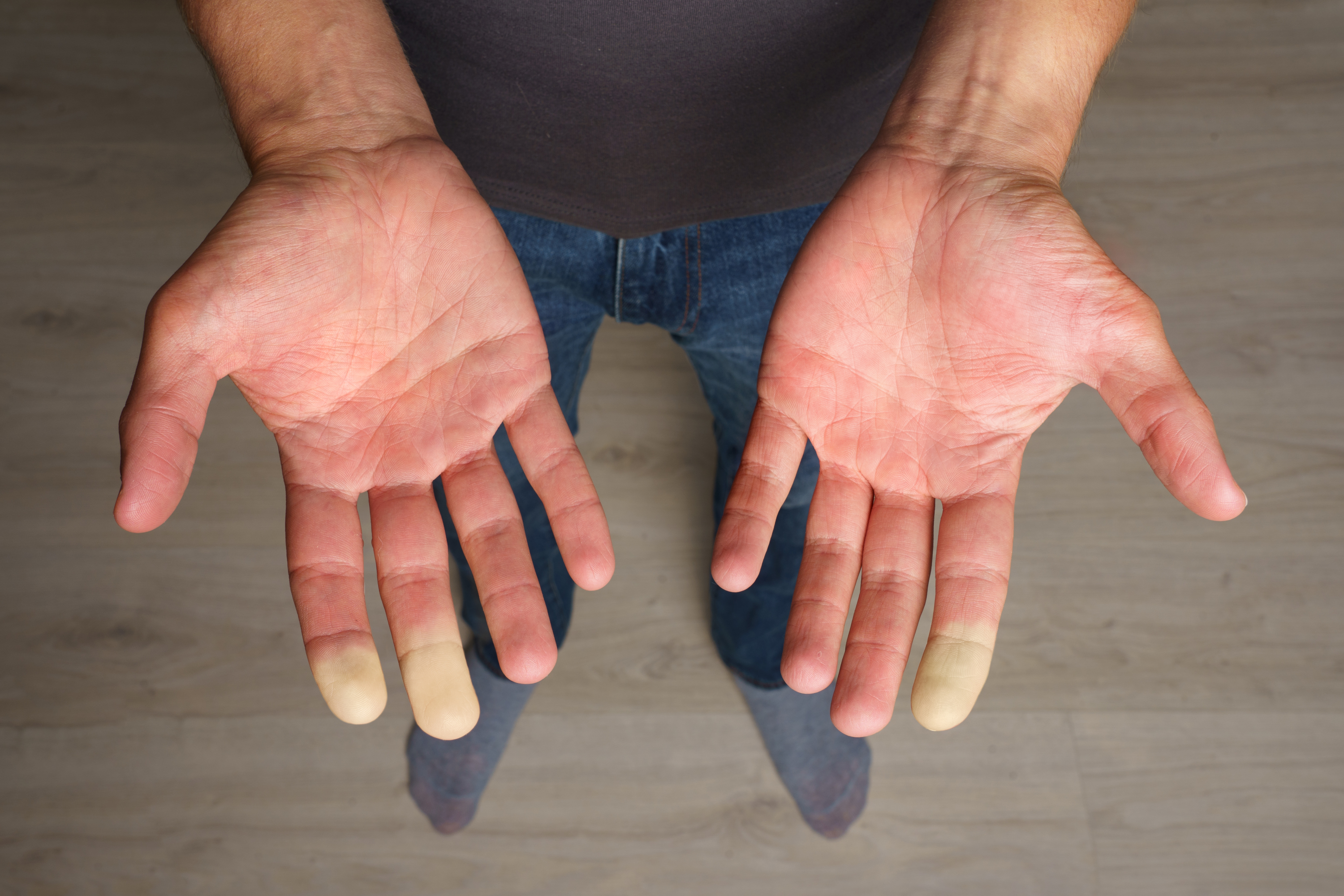 New Outpatient Raynaud Treatment Saves Fingers and Toes