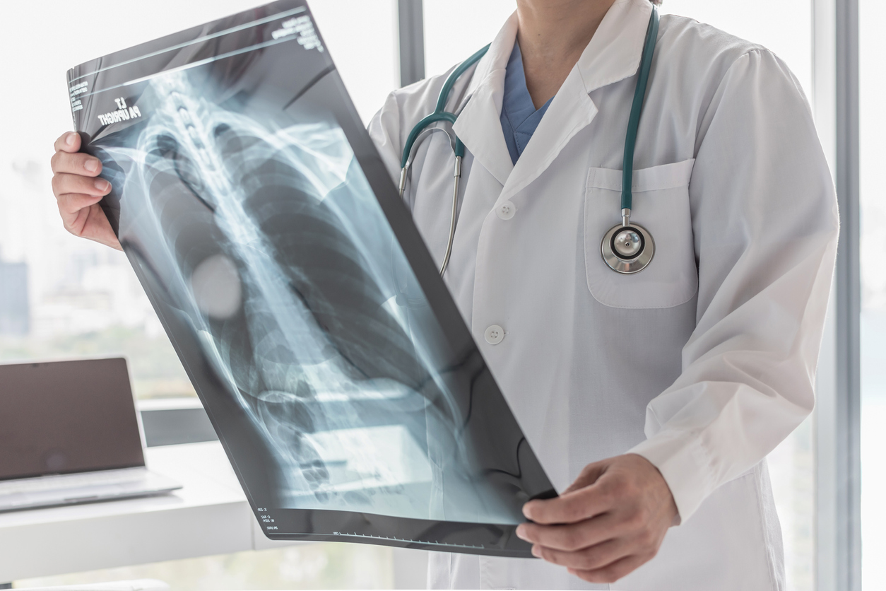 Disparities Found in Lung Cancer Care, Survival in U.S. Versus England