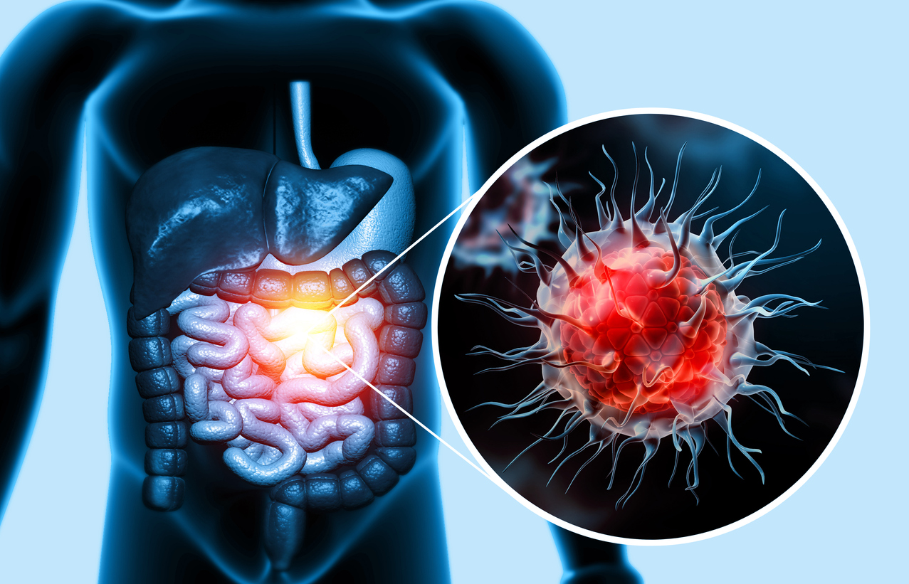 Study Reveals Potential Target for Precision Colorectal Cancer Treatment