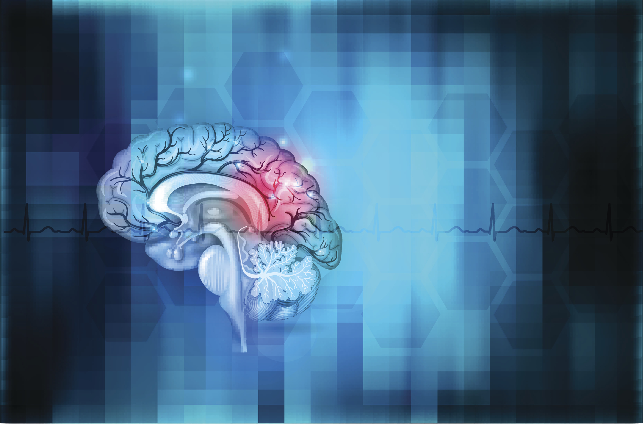 UC Irvine-led Study is First to Find Brain Hemorrhage Cause Other Than Injured Blood Vessels