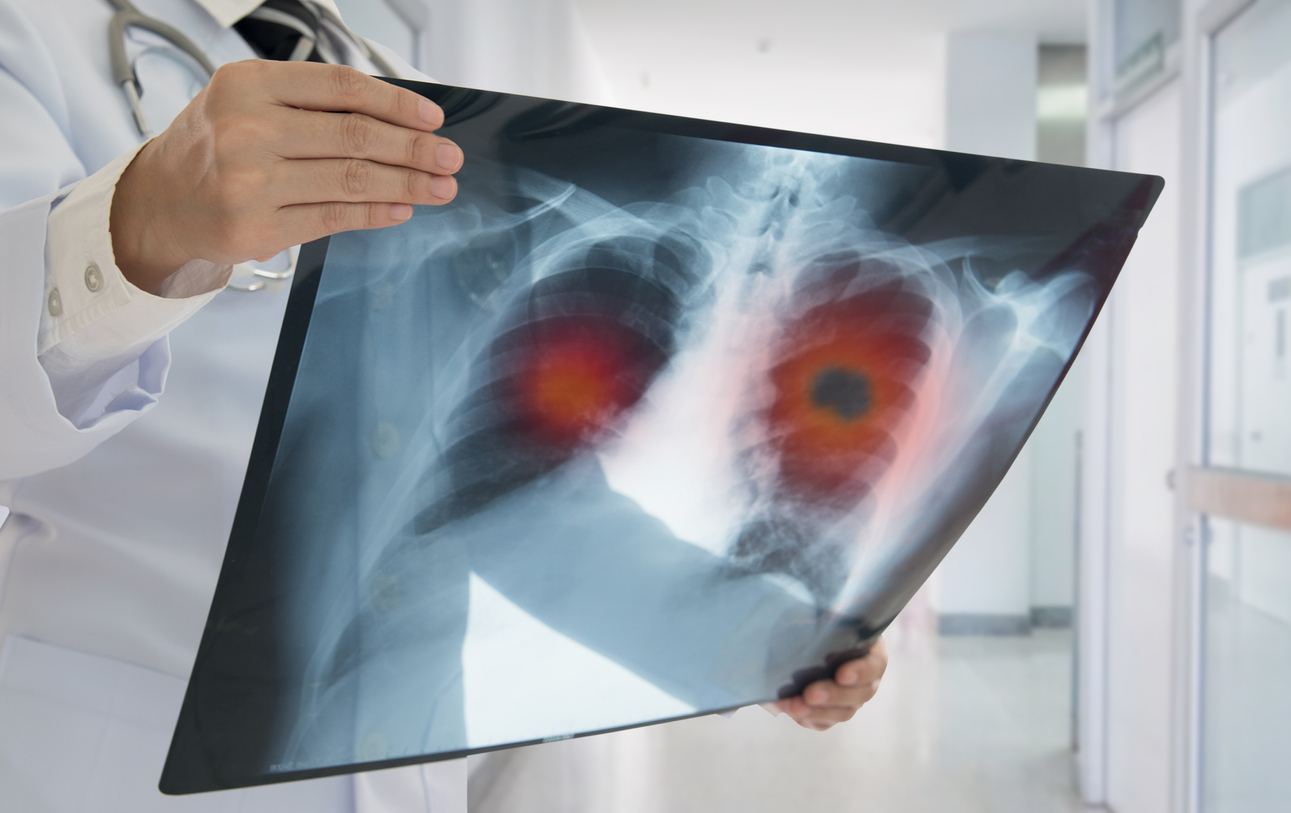Broad Genetic Testing for Advanced Lung Cancer May Not Improve Survival