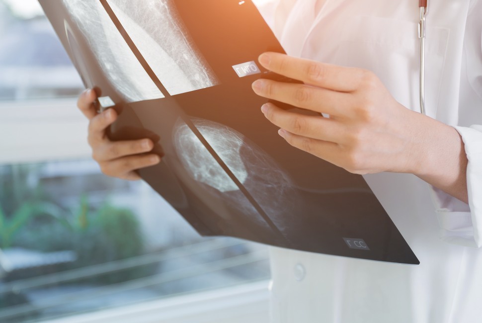 AI May Spare Breast Cancer Patients Unnecessary Treatments