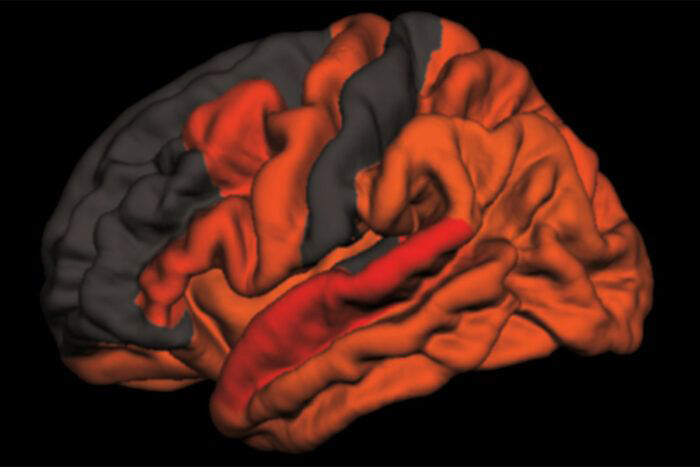 A computer-generated image map of the brain