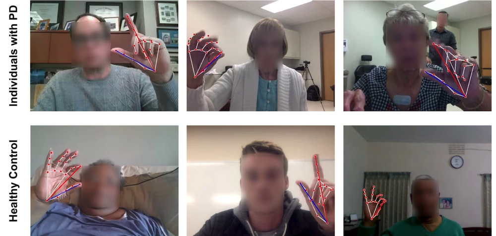 "Online AI-based Test for Parkinson’s Disease Severity Shows Promising Results"