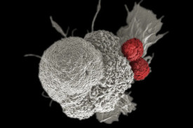 Microscopic image of a cancer cell