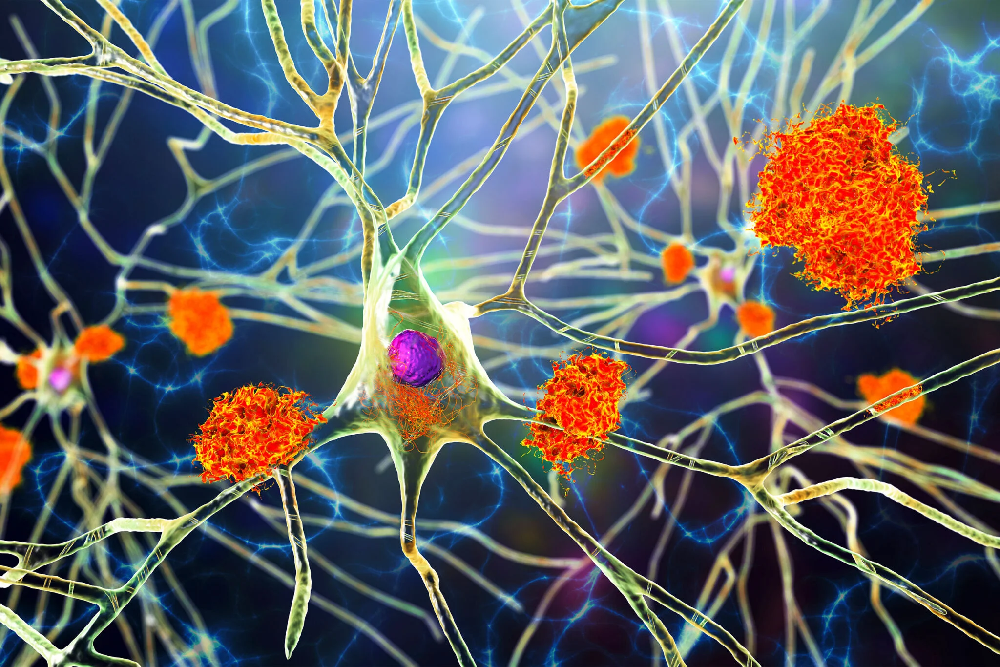 The Road That Ends With Alzheimer’s