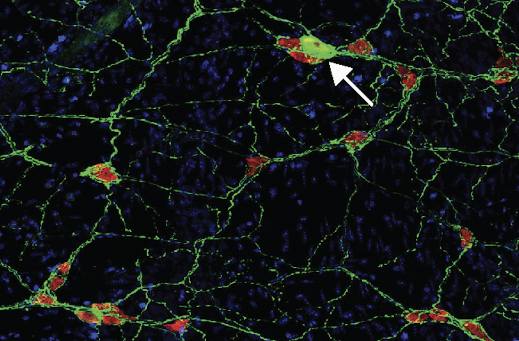 Study Adds to Evidence That Parkinson’s Starts in the Gut