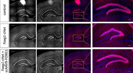 "Study suggests promising gene therapy for FOXG1 syndrome"