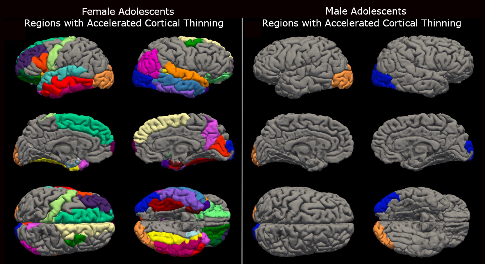 "COVID-19 Lockdowns Prematurely Aged Teenage Brains, UW Study Shows"