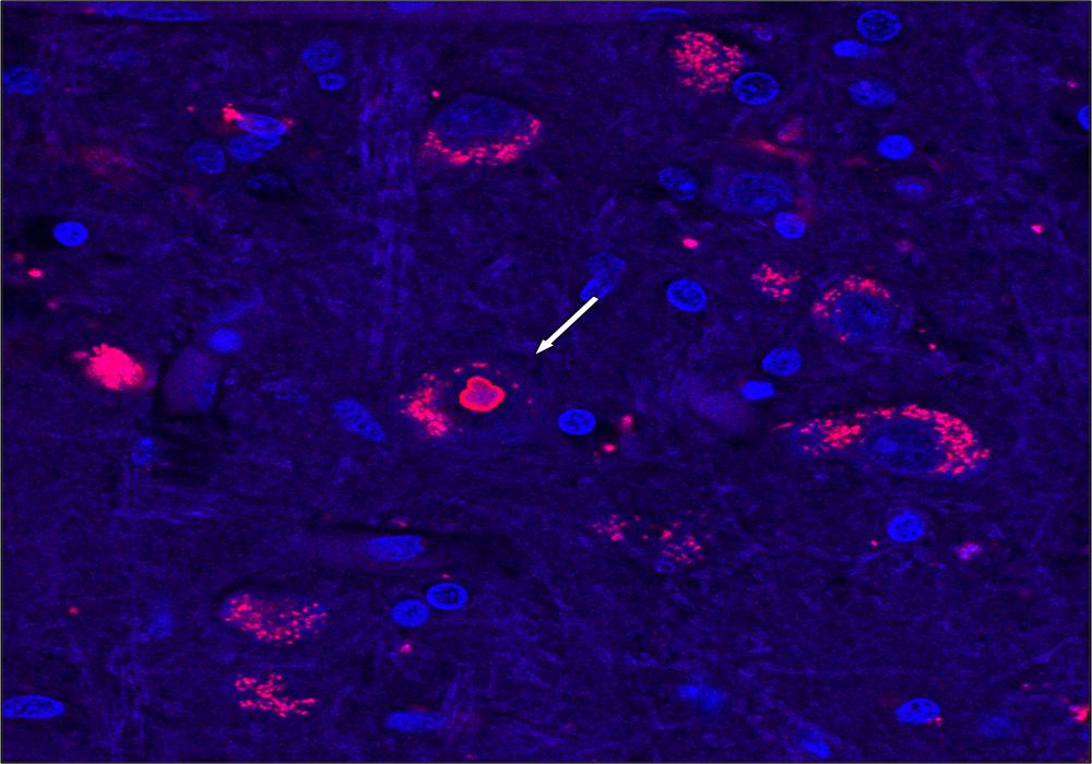 After 25 Years, Researchers Uncover Genetic Cause of Rare Neurological Disease