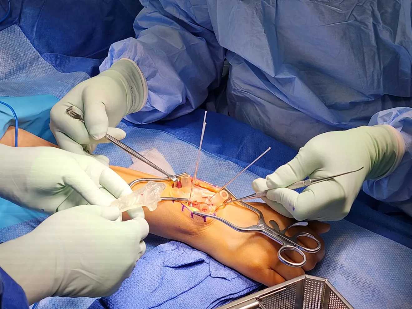 "Yale Begins 3D Orthopaedic Surgical Procedures That Are Fully In-house"
