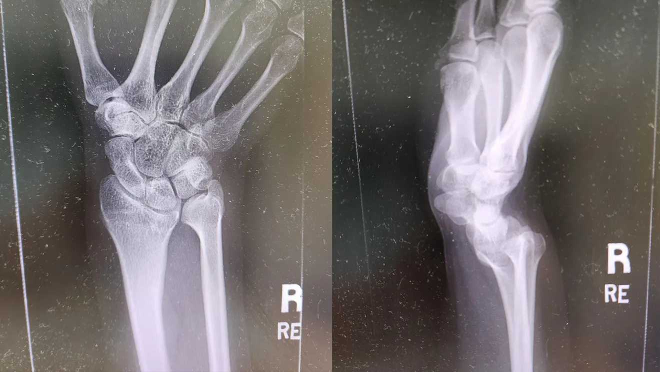 "Yale Begins 3D Orthopaedic Surgical Procedures That Are Fully In-house"