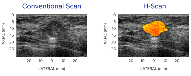 "Patented Ultrasound Technologies Improve Diagnosis for Cancer and Other Diseases"