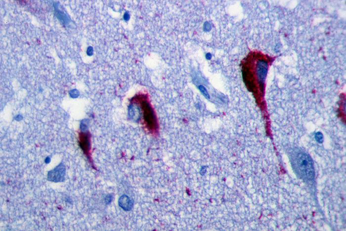 Tangles of tau protein in the brain of a person with Alzheimer's disease.