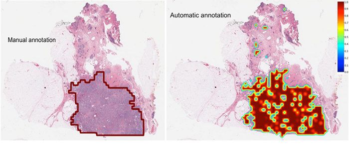 BC-tumor-delineation-700x300-compressor.jpg
