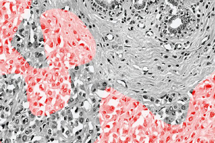 Tumor image