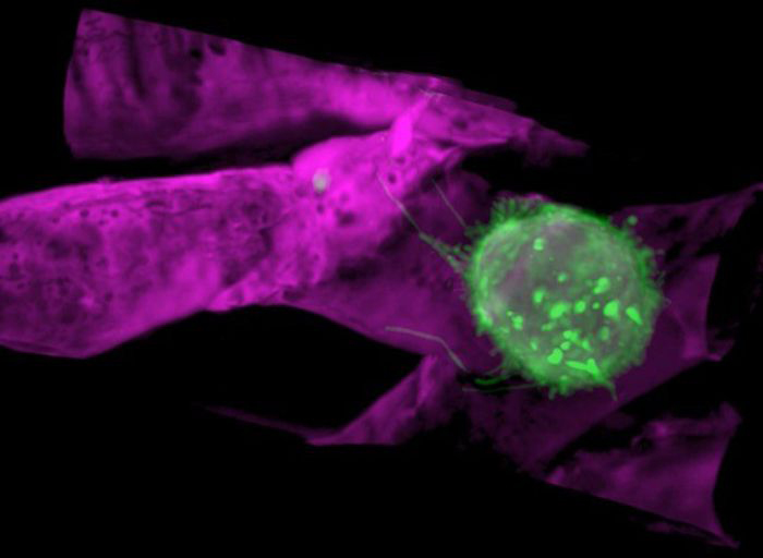 A human breast cancer cell