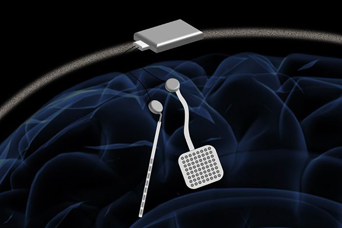 Illuetration: Wireless pacemaker for the brain