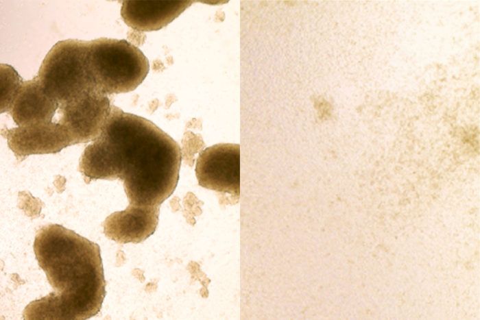 Brain cancer stem cells
