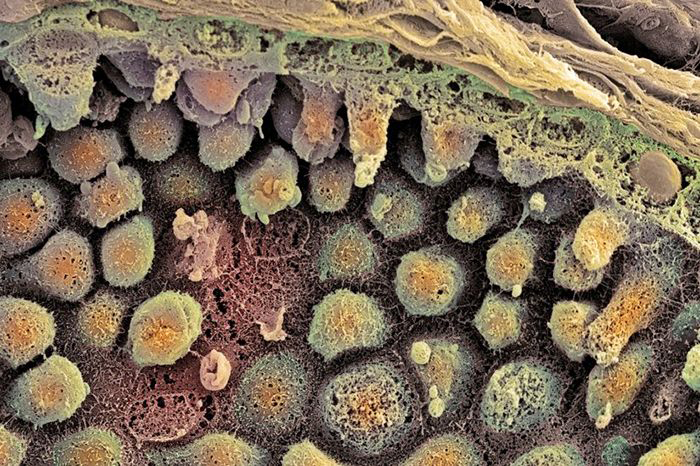 Cancer in the prostate gland