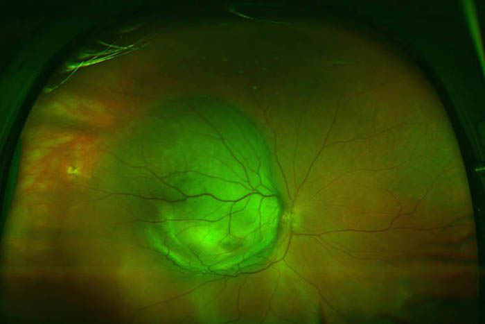 Image of Uveal melanoma