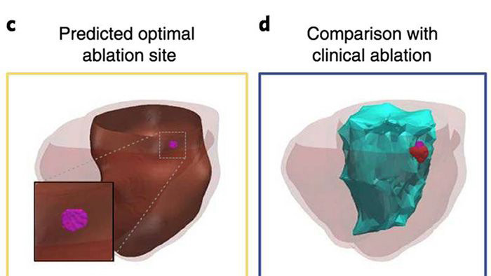 ablation_model_700x394-compressor.jpg