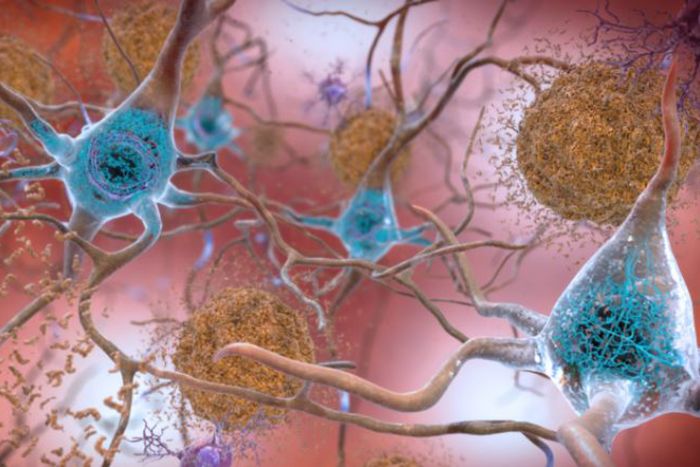 Artist's rendering of amyloid-beta plaque