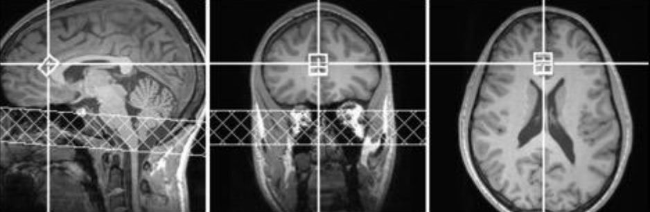MRI of brain