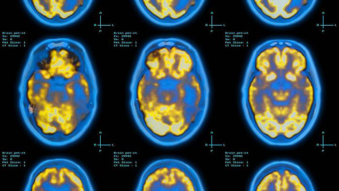 Brain Pet scan