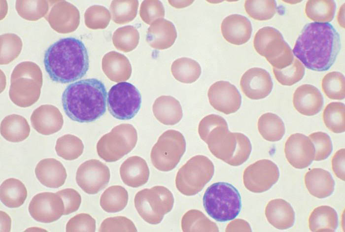 Image of leukemia cells in blood