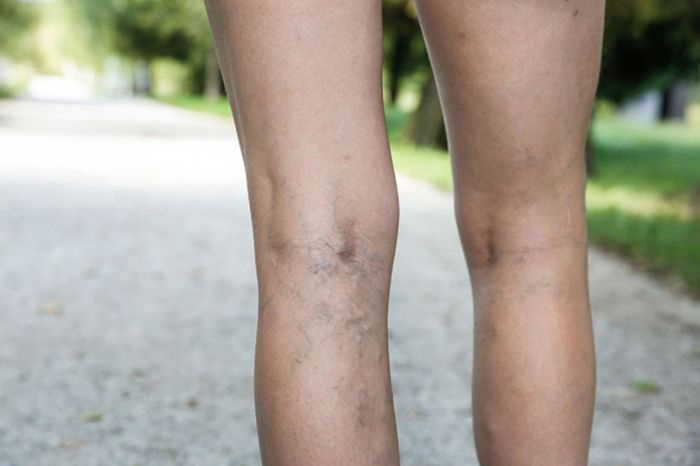 Image of legs with varicose veins