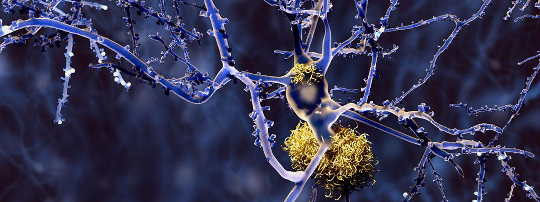 Toxic protein assemblies, or "amyloids", gum up a cell.