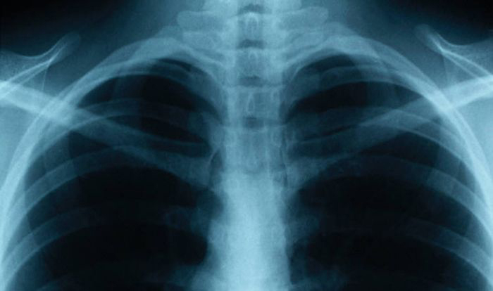 lung x-ray