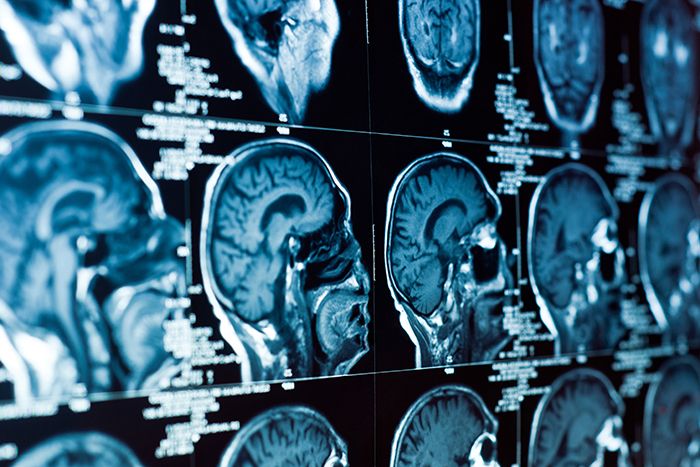 CT scan of brain