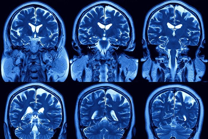 MRI Image of the brain