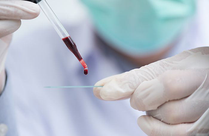 Image: Lab technician dripping blood onto a slide