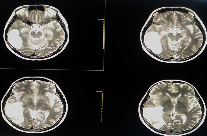 MRI image showing bleeding in brain