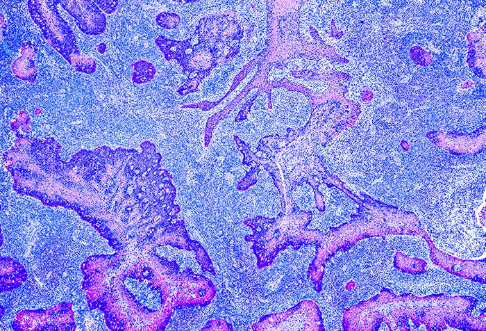 Cancer cells stained with dyes specific to different protein.
