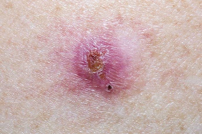 Image: Basal cell carcinoma