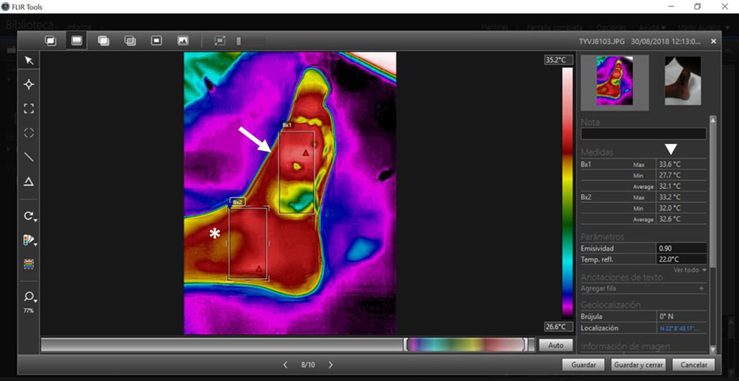 Thermal image of foot